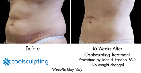 CoolSculpting vs Liposuction: What is The Better Choice?