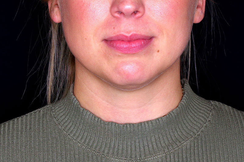 Laser Treatment Before & After Image