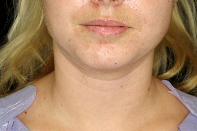 Laser Treatment Before & After Image