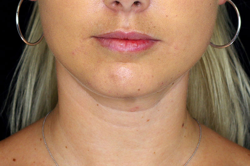 Laser Treatment Before & After Image