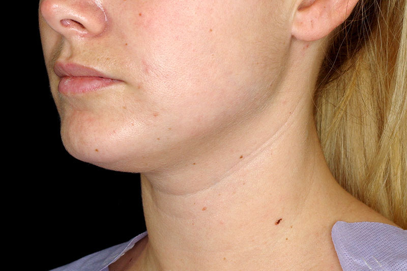 Laser Treatment Before & After Image