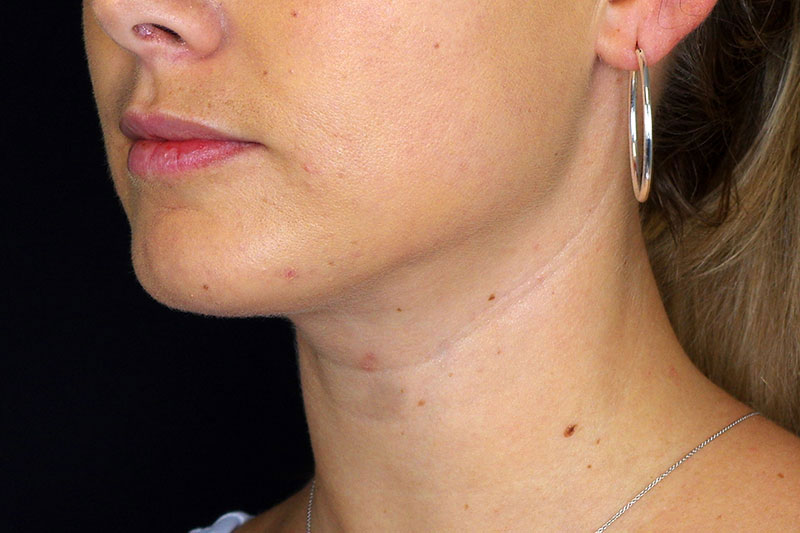 Laser Treatment Before & After Image