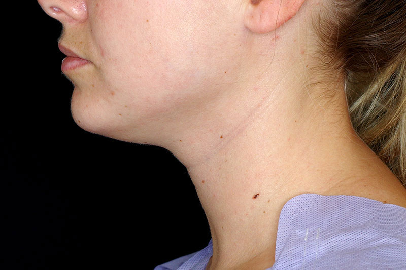 Laser Treatment Before & After Image