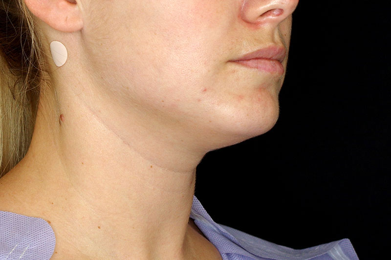 Laser Treatment Before & After Image