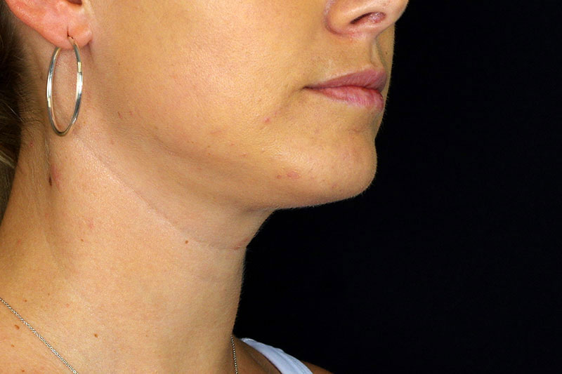 Laser Treatment Before & After Image