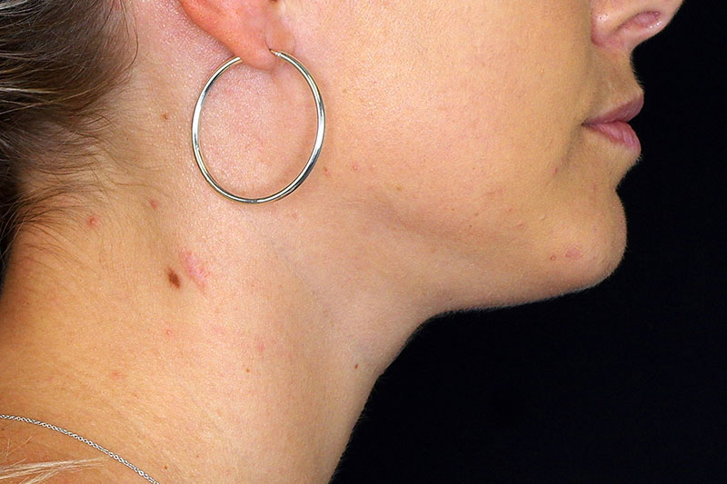 Laser Treatment Before & After Image