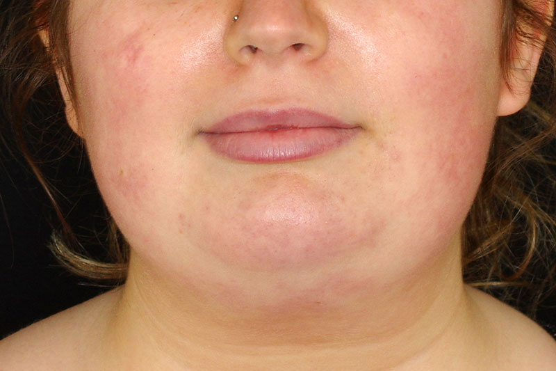 Laser Treatment Before & After Image