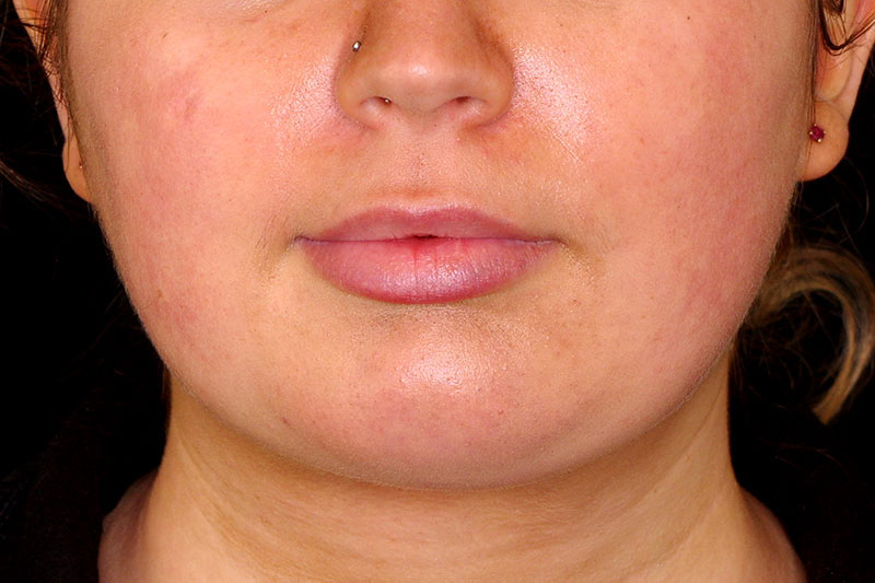 Laser Treatment Before & After Image