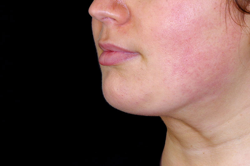 Laser Treatment Before & After Image