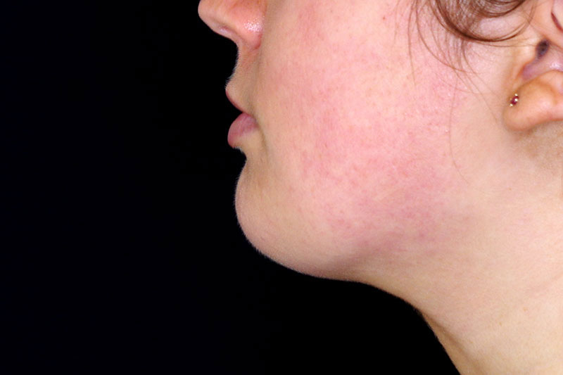 Laser Treatment Before & After Image