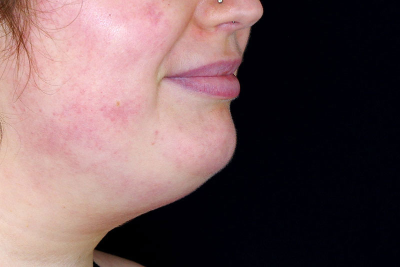 Laser Treatment Before & After Image