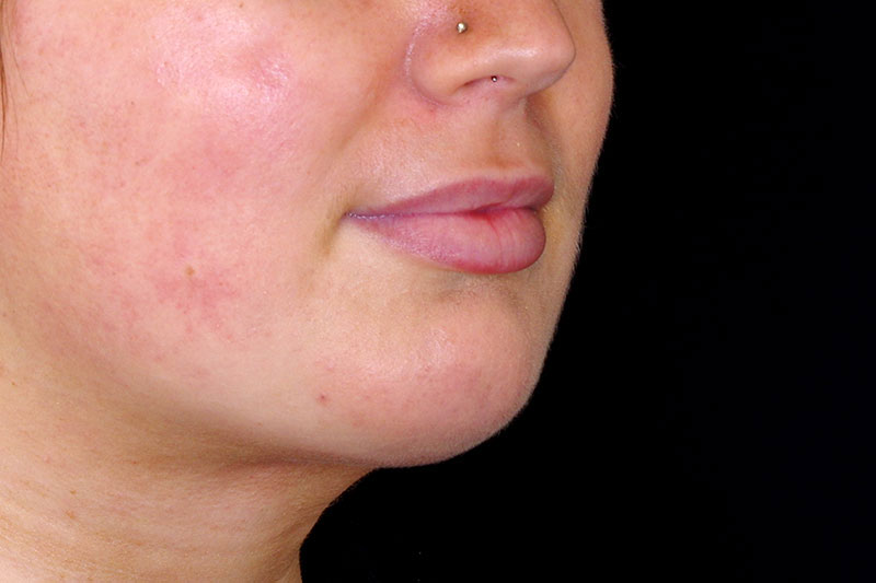 Laser Treatment Before & After Image