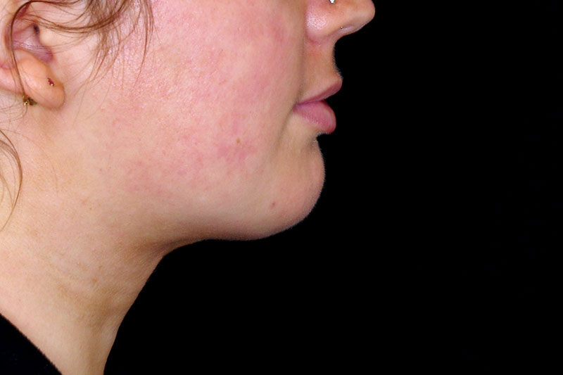 Laser Treatment Before & After Image