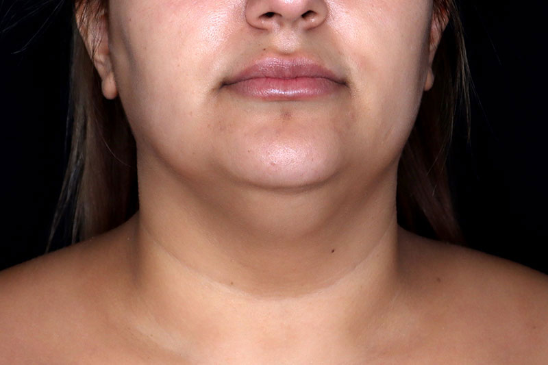 Laser Treatment Before & After Image