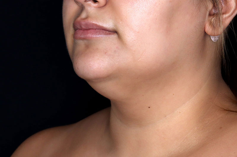 Laser Treatment Before & After Image