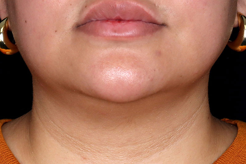 Laser Treatment Before & After Image