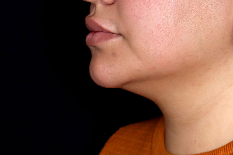 Laser Treatment Before & After Image