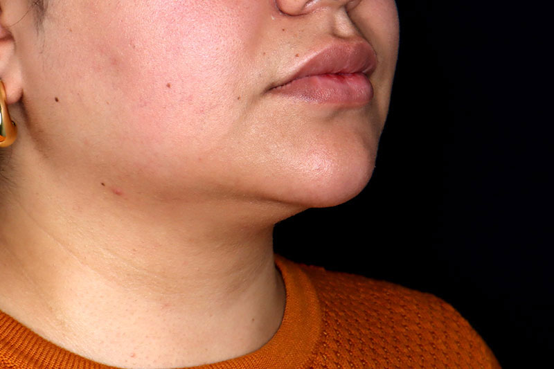 Laser Treatment Before & After Image